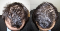 Haartherapie mit Wachstumsfaktoren